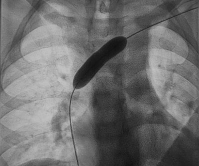 Catheter in subclavian vein. Left subclavian with tumor stenosis. Image shows large-lumen 9-mm balloon after expansion of the stenosis and before the stent is applied. Courtesy of Prof. Dr. Thomas Vogl and University Hospital Frankfurt.
