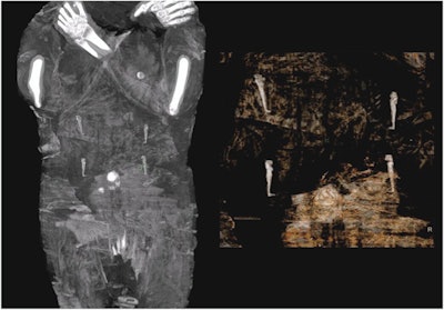 The abdominal area of the mummy with amulets representing the four sons of Horus above the navel area.