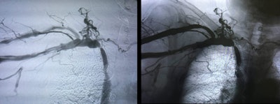 60-year-old male patient with severe stenosis after stent angioplasty of the right brachiocephalic vein. Images courtesy of Prof. Dr. Thomas Vogl and the DRG.