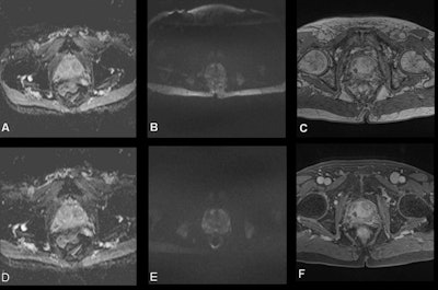 Images (A-C) acquired preoptimization. (A) Apparent diffusion coefficient (ADC) map with large field-of-view. (B) High b-value diffusion-weighted (DW) image with large field-of-view and chemical shift artifact. (C) Dynamic contrast-enhanced (DCE) image without fat suppression technique, 30th measurement post contrast. Following optimization, images (D-F) demonstrated the changes in image quality in the same patient. (D) ADC map with optimal field-of-view. (E) high b-value DW image with optimal field-of-view and without chemical shift artifact. (F) DCE image with fat suppression technique, third measurement post contrast. All figures courtesy of Prof. Shonit Punwani and Insights into Imaging.