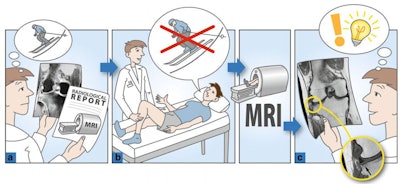 In this grade 3 change, the patient fell during skiing and now had left knee pain, according to the general practitioner. MRI showed pronounced high T2 signal in the lateral tibia, which was interpreted as post-traumatic edema following a skiing injury (a). After direct communication with the patient, the patient reported that he had never skied in his life and had never fallen. The pain would usually arise spontaneously at night (b). The authors retrospectively recognized a subchondral crescent sign in the tibia and interpreted the event as atraumatic osteonecrosis (c). A follow-up MRI three months later showed complete recovery of the subchondral bone fracture. All figures courtesy of Dr. Andreas Gutzeit and colleagues and European Radiology.