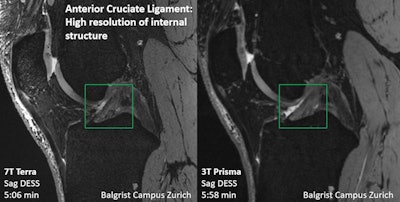 Direct comparison of the ACL with 7T and 3T. Image courtesy of Dr. Reto Sutter.