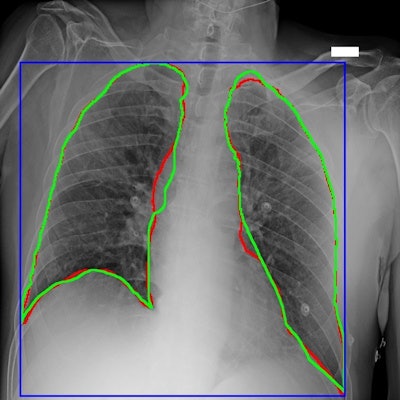 AIforCOVID Imaging Archive has been published to aid development of AI algorithms. Image courtesy of Bracco.