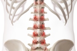 2021 05 25 22 49 1040 3d Rendered Arthritic Lumbar Spine 400