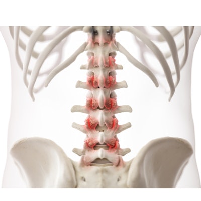 2021 05 25 22 49 1040 3d Rendered Arthritic Lumbar Spine 400
