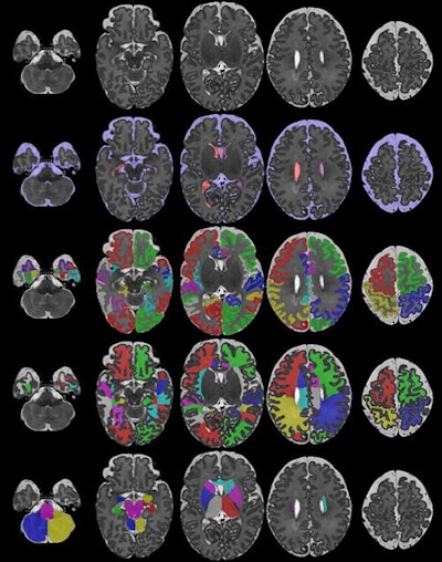 Researchers are working out how the brains of new-born babies develop by applying AI techniques to these MRI scans taken as part of the Developing Human Connectome Project, led by King's College London, Imperial College, and the University of Oxford. Image courtesy of the Developing Human Connectome Project.