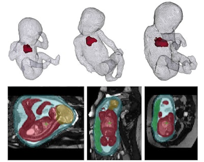 Smart thinking AI is being used to automatically localize the fetus and its heart in MRI images of a mother's uterus as part of the iFind (intelligent Foetal Imaging Diagnosis) project. Image courtesy of Alena Uus, PhD.