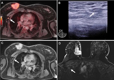 Pathologically confirmed axillary lymph node metastasis that was correctly identified on F-18 FDG PET/MRI (A) because of tracer uptake above background levels (SUVmax 4.3) and in axillary sonography (B) because of cortical enlargement to 3.8 mm (short-axis diameter 8 mm). This lymph node was rated unsuspicious on thoracic MRI (C) and breast MRI (C). Large primary cancer is seen in the right breast (D). Figure courtesy of Journal of Nuclear Medicine.