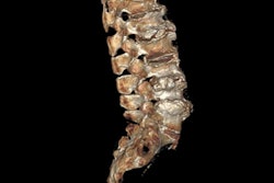 2021 05 27 18 57 7628 2021 06 01 Ct Vertebral Fractures Slide1 400