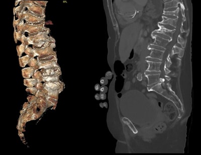 With body CT scanning, performing sagittal bone reformats of the spine does not require additional scan times or radiation dose, nor does it require significant additional storage space. To increase VFF detection on body CT, sagittal reconstruction of the spine using bone windows should be sent routinely to PACS for storage and display.