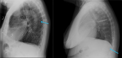 Radiologists and reporting radiographers are well-placed to diagnose VFFs on any modality that can provide images of the spine, including x-ray. All images courtesy of Dr. Anagha Parkar, Bergen, Norway.