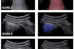 Left: Examples of lung ultrasound images corresponding to score 3 (top), score 0 (middle), and score 2 (bottom). Right: the corresponding semantic segmentations obtained with the described deep-learning algorithms. Color maps are informative of the score level (red for score 3, blue for score 0, orange for score 2), as well as indicate the relevant part of the image that determines the score. These maps explain the decision progress of the algorithms. Images and caption courtesy of Libertario Demi, PhD.