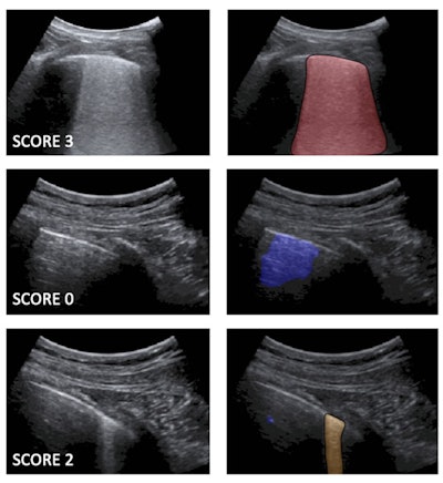 Left: Examples of lung ultrasound images corresponding to score 3 (top), score 0 (middle), and score 2 (bottom). Right: the corresponding semantic segmentations obtained with the described deep-learning algorithms. Color maps are informative of the score level (red for score 3, blue for score 0, gold for score 2), as well as indicate the relevant part of the image that determines the score. These maps explain the decision progress of the algorithms. Images and caption courtesy of Libertario Demi, PhD.