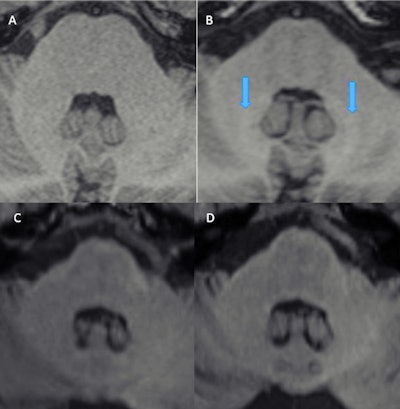 Dentate nucleus prior to (A) and after nine serial injections (B) of the linear GBCA gadopentetate and prior to (C) and after 10 injections of the macrocyclic GBCA gadoterate dimeglumine (D). Clear hyperinstensities are visible in the dentate nucleus in B (blue arrows), while no hyperintensities display in the dentate on D. Figure courtesy of Prof. Dr. Alexander Radbruch, JD.