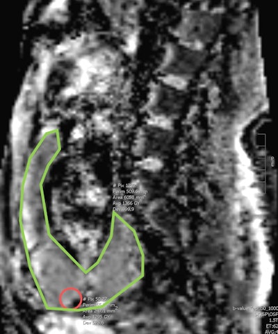 ADC MRI of a sagittal section shows areas of whole placenta segmentation (marked in green) and a small area of regional segmentation (red circle). Figures courtesy of Hiba Alessa and Dr. Elspeth Whitby.