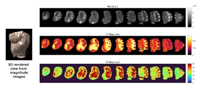 Customized 3D MR fingerprinting in vivo in the hand and wrist engineered for very low-field MRI and developed at the AMT Center in Basel. 15 slices were generated in 8.5 minutes. Figures courtesy of Najat Salameh, PhD, and Mathieu Sarracanie, PhD.
