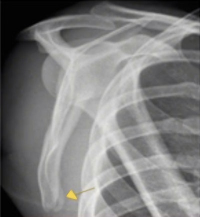 X-ray showed a minimally displaced fracture in the scapula of this professional football player. The diagnosis was later confirmed by CT.