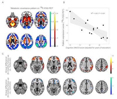 (A) COVID-19-related spatial covariance pattern of cerebral glucose metabolism overlaid onto an MRI template. Voxels with negative region weights are color coded in cool colors and regions with positive region weights in hot colors. (B) Association between the expression of COVID-19-related covariance pattern and the Montreal Cognitive Assessment (MoCA) score adjusted for years of education. Each dot represents an individual patient. (C) Results of a statistical parametric mapping analysis. Upper row illustrates regions that show significant increases of normalized FDG uptake in COVID-19 patients at six-month follow-up compared with the subacute stage (paired t-test, p < 0.01, false discovery rate-corrected). Bottom row depicts regions that still show significant decreases of normalized FDG uptake in COVID-19 patients at six-month follow-up compared with the age-matched control cohort at an exploratory statistical threshold (two-sample t-test, p < 0.005). Image courtesy of Ganna Blazhenets, et al.