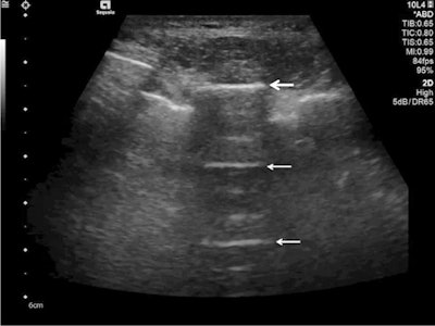 Ultrasound detected A-lines using an abdominal probe. A-lines (white arrows) appear as bright horizontal lines deep to the pleural line (bold white arrow).