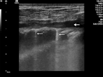 Lung ultrasound using a linear probe. B-lines (white arrows) with irregular pleura and a small pleural effusion (bold white arrow).