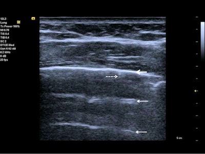 Follow-up of an intensive care unit patient with COVID-19 pneumonia after mechanical ventilation. An indirect sign of recovery is the appearance of A-lines (white arrows) through the recovery phase. No major pleural fragmentation (bold white arrow) is seen, but a mirror effect is visible (left white arrow). All figures courtesy of Dr. Dirk-André Clevert and colleagues and Insights into Imaging.