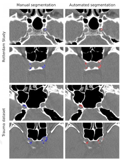 Examples of manual and automated segmentations of Rotterdam Study and trauma dataset scans. The images shown were preprocessed. Trauma dataset images were additionally smoothed with a Gaussian filter to make them more similar to Rotterdam Study scans used for training and thus improve the method's performance. Images and caption courtesy of the RSNA.
