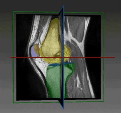 An image from RSIP Vision's cartilage segmentation tool for sports medicine applications. Image courtesy of RSIP Vision.