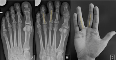 (A) Negative Vulcan salute sign in a 50-year-old woman from the control group. (B) Positive Vulcan salute sign (V-sign) of the 3/4 interspace in a 46-year-old woman with Morton's neuroma. (C) 'Vulcan salute' from one of the authors. Image courtesy of Skeletal Radiology.