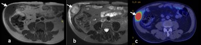 T1-weighted (A) and T2-weighted fat suppressed MRI (B) and PET-CT (C) images of transitional cell carcinoma recurrence within the right anterolateral abdominal wall scar (white arrow).