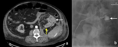 (A) Arterial phase CT image of perinephric hematoma (white arrow) at the site of partial nephrectomy. The residual left kidney is indicated by the yellow arrow. (B) Active extravasation of contrast (white arrow) was confirmed on digital subtraction angiography. All figures courtesy of Dr. Jean S.Z. Lee and colleagues and Insights into Imaging.