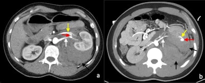 Postcontrast arterial phase axial CT images of vascular complications following nontargeted ultrasound-guided 14-gauge core biopsies of the left kidney in two patients. (A) Arteriovenous fistula. There is a fistulous connection (red arrow) between the left renal artery (white arrow) and the left renal vein (yellow) with associated early arterialised enhancement of the proximal left renal vein, medial to the arteriovenous fistula. There is an associated retroperitoneal hematoma (black arrow). (B) Arterial pseudoaneurysm. A small pseudoaneurysm (red arrow) arising from a segmental branch of the left renal artery (yellow arrow) is visualized as an adjacent small focus of rounded arterial enhancement (red arrow). The main left renal artery is also visible (white arrow). There is an associated left perinephric and retroperitoneal hematoma (black arrows).