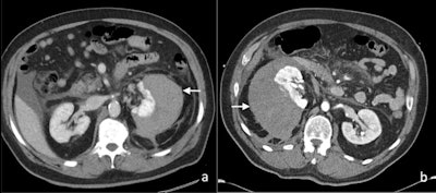 Axial contrast-enhanced CT images of (A) perinephric hematoma (white arrow), and (B) subcapsular hematoma (white arrow) postextracorporeal shock wave lithotripsy in two patients.
