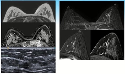 A 32-year-old patient with the BRCA-2 gene underwent her second MRI screen. Left images show a T2 sequence showing low signal intensity fibroadenoma with corresponding high apparent diffusion coefficient, and the ultrasound correlate. On the right is the maximum-intensity projection, the subtraction images postgadolinium, and the high-resolution delayed T1 with fat-suppressed gradient echo. These show new segmental nonmass enhancement. Images courtesy of Dr. Lucinda Frank and colleagues.