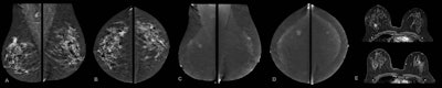 Contrast-enhanced mammography exam of both breasts in two views