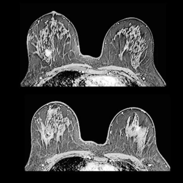 Dutch researchers issue novel analysis on best use of breast MRI ...