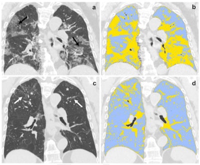 (a,b) Baseline and (c,d) six-month follow-up coronal thin-section unenhanced chest CT scans of 79-year-old man, admitted to the emergency department presenting fever, dyspnea, and cough; COVID-19 was confirmed by RT-PCR testing. (a) Chest CT scan shows bilateral ground-glass opacities tending to consolidation (black arrow). (b) The same scan after QCCT analysis highlighted in light-blue well-aerated lung (1.5 liters, 50%) and in yellow pulmonary injury of COVID-19 pneumonia. (c) Six-month follow-up scan shows residual fibrotic-like changes (white arrows) and persisting of low-density ground glass (asterisks). (d) The same scan after QCCT analysis highlighted in light-blue well-aerated lung (3.5 liters, 82%) and in yellow residual findings of COVID-19 pneumonia at six months follow-up. Images and caption courtesy of the RSNA.