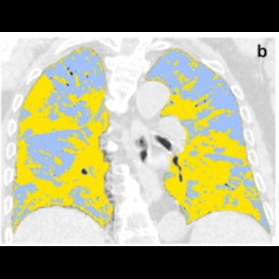 2021 07 30 23 36 5589 2021 07 28 Radiology Caruso Figure4 Image B