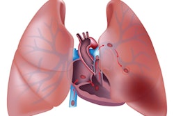 2021 08 11 23 55 9301 Pulmonary Embolism Illustration V2 400