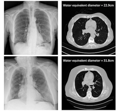 The x-ray attenuation of the patient calculated from the DICOM header information of chest x-rays, and compared with CT gold-standard size measures. Image courtesy of Hilde Bosmans.