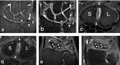 A 32-year-old male healthy volunteer (a, b), a 22-year-old male healthy volunteer (c, d), and a 27-year-old female healthy volunteer (e, f). (a) 7-tesla 0.5-mm-thick coronal 3D proton density (PD) turbo spin-echo (TSE) section and (b) 3-tesla 0.5-mm-thick coronal 3D PD SPACE section with a depiction of the ulnar styloid attachment (arrowheads), the foveal attachment (arrow), and the radial attachment (arrowhead) of the triangular fibrocartilage complex. (c) 7-tesla 0.5-mm-thick axial 3D PD TSE section and (d) 3-tesla 0.5-mm-thick axial 3D PD SPACE section with visualization of the dorsal portion (arrow), and the palmar portion (arrowhead) of the scapholunate ligament. (e) 7-tesla 0.5-mm-thick coronal 3D PD TSE section and (f) 3-tesla 0.5-mm-thick coronal 3D PD SPACE section depicts the dorsal portion of the scapholunate ligament (arrowheads). S = scaphoid; SPACE = 'sampling perfection with application-optimized contrasts using different flip angle evolution'. All images courtesy of Dr. Simon Götestrand et al. and European Radiology.