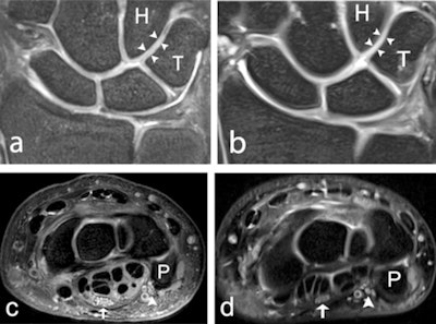 A 39-year-old male healthy volunteer. (a) 7-tesla and (b) 3-tesla coronal 2D PD-weighted section, showing the articular cartilage (arrowheads) between the hamate and the triquetrum. Articular cartilage between other bones is also visible. (c) 7-tesla and (d) 3-tesla axial 2D PD-weighted section, showing the median (arrow), and ulnar nerve (arrowhead), at the level of the pisiform bone. H = hamate; P = pisiform; PD = proton density; T = triquetrum.