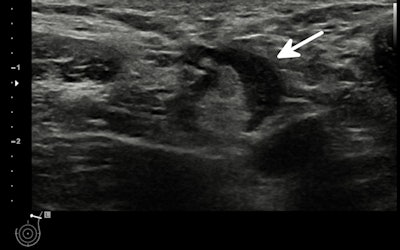 Ultrasonography of the left axilla shows an enlarged 17 mm reactive lymph node in a 45-year-old woman about a week after receiving the firrst dose of the Vaxzevria COVID-19 vaccine (Astra Zeneca). Note the asymmetrical cortical thickening (white arrow) associated with a well-represented central fatty hilum. All images courtesy of the EUSOBI and Insights into Imaging.