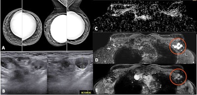 Screening mammography performed in a 44-year-old woman with a positive family history for breast cancer (mother and aunt), bearing implants for aesthetic purposes. Mammography (A) was considered negative. Breast ultrasonography was also performed because of her family history and high breast density (ACR category D). While ultrasonography was negative for both breasts, multiple round, enlarged, hypoechoic lymph nodes (measuring up to 1 cm in axial diameter), with a thickened (< 3 mm) cortex, were seen in the left axilla (B). There were no skin changes and there was no history of any infection or trauma. On the right side, axillary lymph nodes were normal. Because of her family history and the presence of breast implants, MRI was performed (C = apparent diffusion coefficient map; D = T2-weighted short-time inversion recovery; E = fat-saturated contrast-enhanced T1-weighted gradient-echo). No suspicious mass or nonmass lesions were seen in both breasts. Implants displayed no signs of rupture (not shown). In the left axilla, multiple enlarged lymph nodes were well visible in D and E (red circles); on the apparent diffusion coefficient map (C), they mainly exhibited low signal (restricted diffusivity). When an ultrasound-guided biopsy of the most suspicious lymph node was proposed, the patient mentioned that she had had a Comirnaty COVID-19 vaccination (Pfizer-BioNTech) one week before in the left arm. The attending radiologist was more than surprised to hear this, as at that time, a COVID-19 vaccination was only administered to people older than 70 years. Follow-up performed four weeks after the second vaccination was negative and showed no residual enlarged lymph nodes.