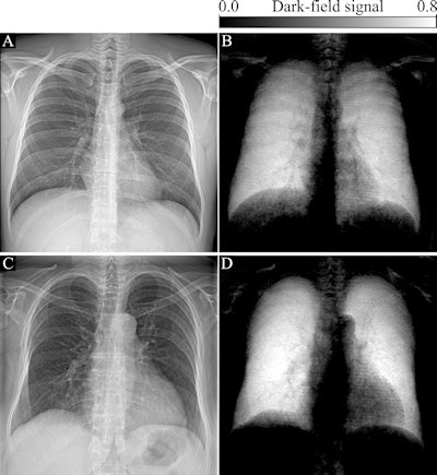 Attenuation-based (left) and dark-field (right) posteroanterior radiographs of the thorax in example subjects. Images were obtained in (A, B) a 33-year-old man and (C, D) an 81-year-old man. The same window and level settings were applied within the respective modality. While attenuation-based images show attenuating structures, such as the bones and the soft tissue, dark-field images show the amount of tissue interfaces in the beam path. Image courtesy of Radiology.