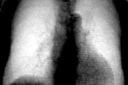 2021 08 26 21 13 2745 2021 08 27 Gassert Xray Lung 400