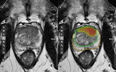 Figure demonstrating the output of the deep learning-based software. The image on the left shows the original T2-weighted image without any overlaying graphics. The image on the right demonstrates the algorithm output consisting of a heat map, which is an image that represents the detection network's response qualitatively by high signal intensities in suspected lesion areas. The image also shows an estimated Prostate Imaging Reporting and Data System (PI-RADS) category, lesion localization, and 3D contours (orange = peripheral zone, green = transition zone). Image courtesy of Dr. David Winkel.