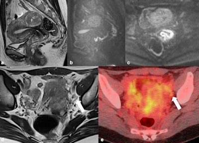43-year-old woman. The tumor crawls on the surface of the anterior lip of the cervix to anterior fornix of vagina. (b) Sagittal and (c) axial diffusion-weighted imaging (DWI) clearly show tumor extension to the anterior vaginal fornix. Vaginal wall invasion was suspected at anterior fornix by irregularity. This case was diagnosed as stage IIA in 2017 under the previous International Federation of Gynecology and Obstetrics (FIGO) stage system. (d) Round lymph node about 8 mm in diameter was observed at the left obturator node (arrow). (e) FDG-PET/CT showed mild uptake, with suspected lymph node metastasis. At operation, lymph node metastasis was conﬁrmed. Therefore, this case is stage IIIC1 at the present FIGO stage. Figure courtesy of BJR.