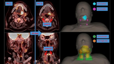 A second-look PET/CT scan revealed two newly involved lymph nodes in level II bilaterally and two in level III bilaterally. Based on this information, nodal high-risk volumes were added, and the elective volume was enlarged to include levels Va+b bilaterally. Note the positioning discrepancy between two PET/CT scans because the first was diagnostic only, whereas the second was acquired in the treatment position. Image courtesy of Clinical and Translational Radiation Oncology.