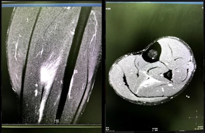 MRI has an essential role in imaging of football injuries. MR images (1.5 tesla sagittal and axial) show a muscle strain in a football player's lower leg. The strain occurred during the 2018 World Cup.