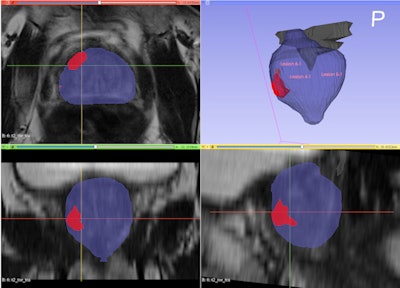 The figure above illustrates the RTSTRUCT format segmentations output by the software. The segmentations are overlaid on a 3D multiplanar reconstruction of the T2 axial image, together with the 3D mesh view.